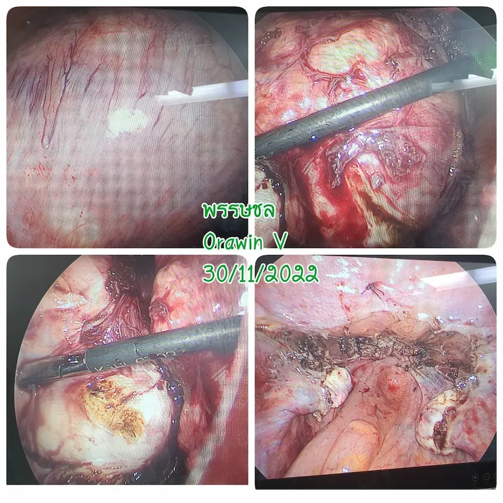 ภาพจากกล้องขณะผ่าตัด